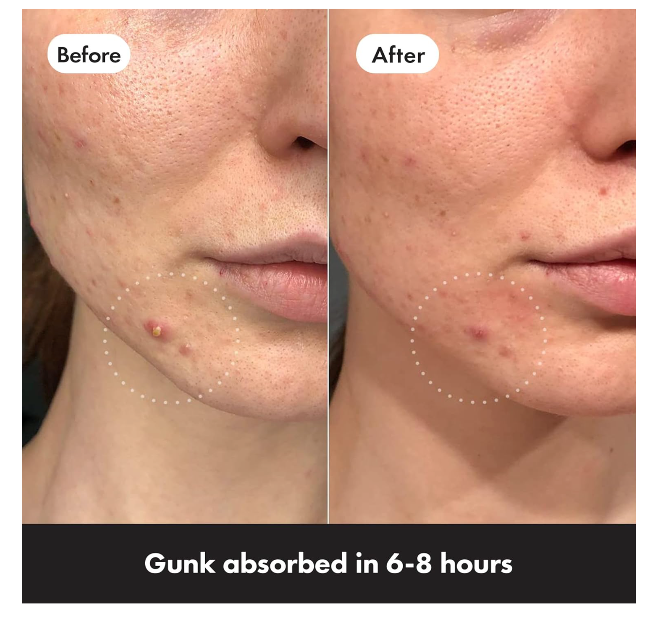 Hydrocolloid Pimple Patches - Invisible Acne Treatment ( Hero)